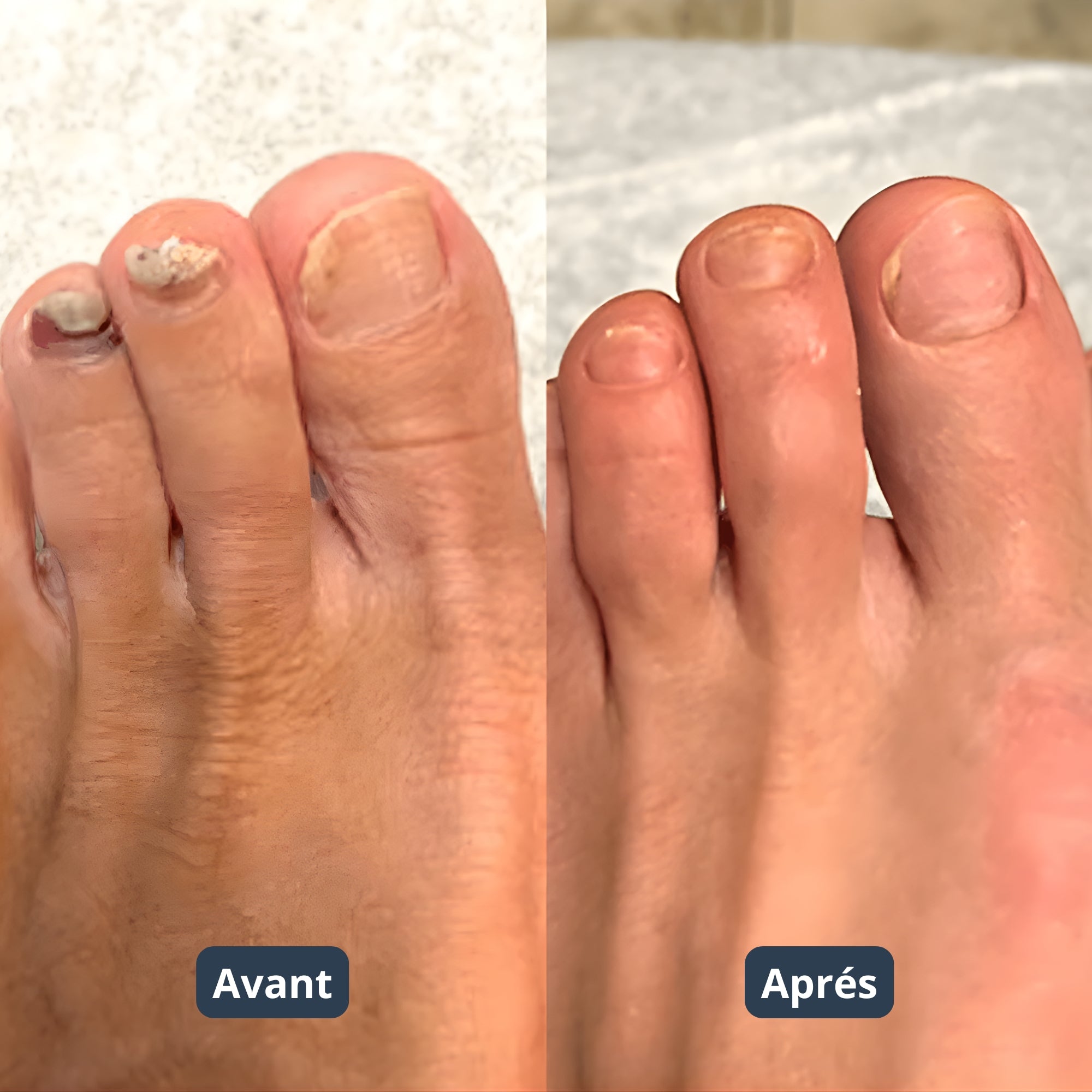 Purinyx DuoBeam™ Appareil Laser Pour Mycoses Des Ongles